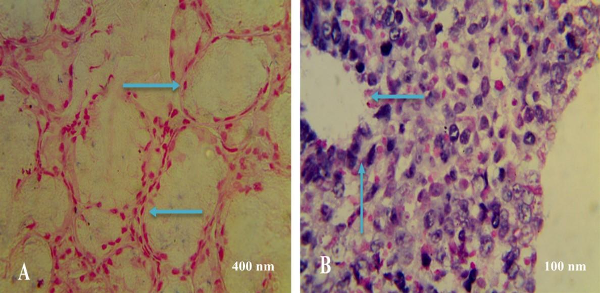 Histological and physiological determinants of hypothyroidism in patients and its relationship with lipid profile