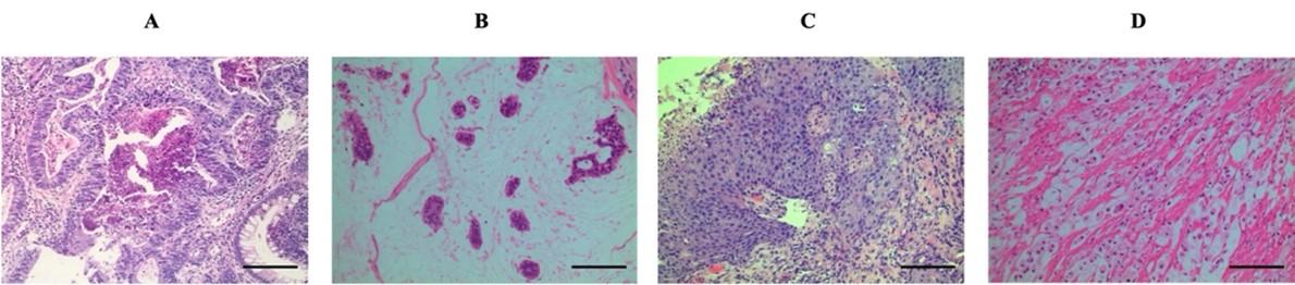 Study on relationship between genetic abnormalities and clinicopathological features in K hospital’s patients with colorectal cancer