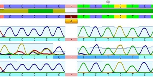 Influence of the high mobility group A1 genetic polymorphism on indices of metabolic syndrome and insulin resistance in the Iraqi population: Case-control study