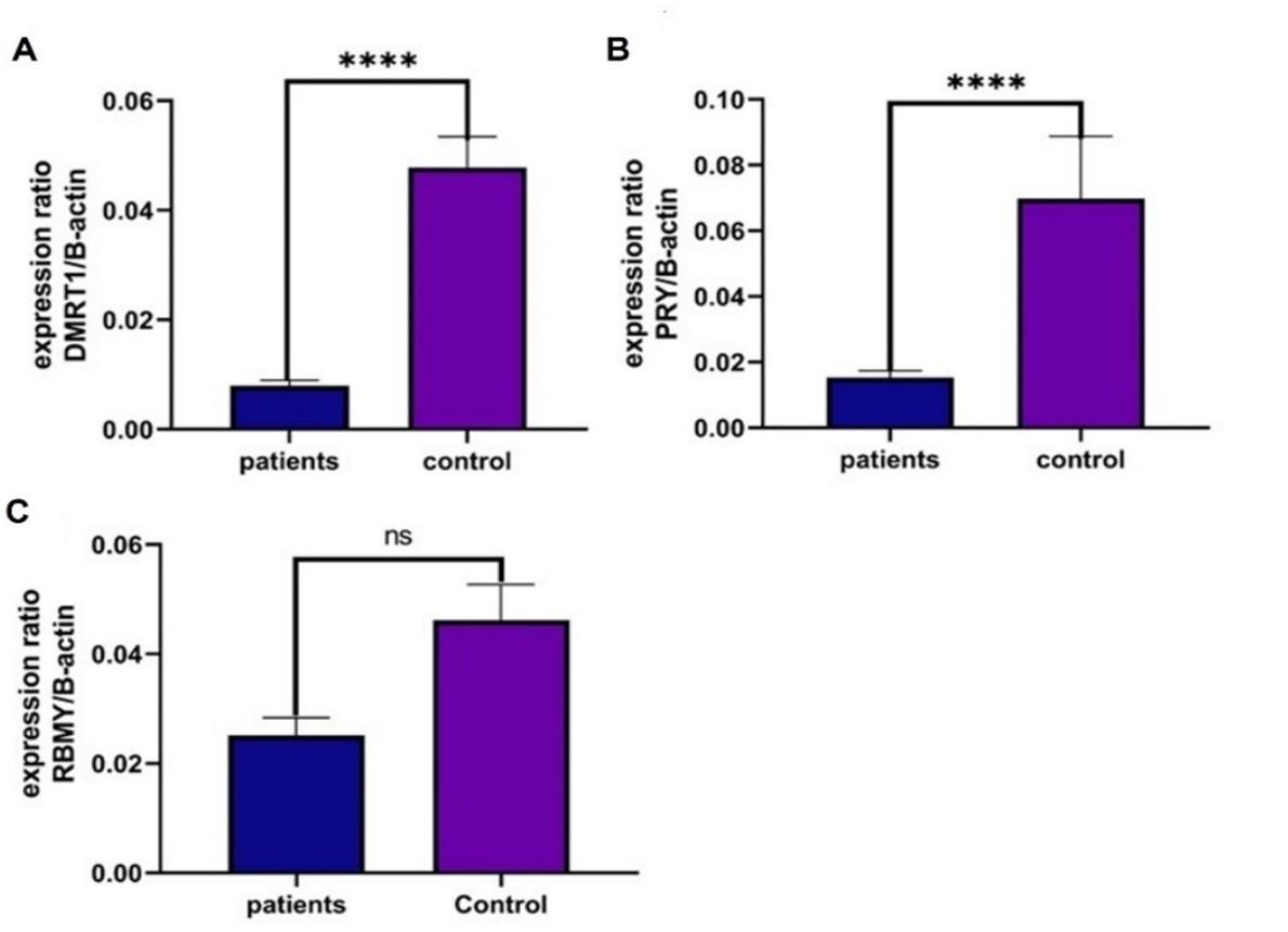 DMRT1, RBMY, and AZFb genes polymorphism and expression role in azoospermia susceptibility