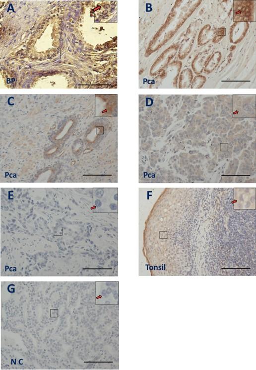 Increased CD73 expression is associated with poorly differentiated Gleason score and tumor size in prostate cancer