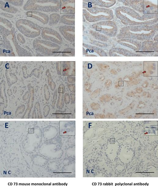 Increased CD73 expression is associated with poorly differentiated Gleason score and tumor size in prostate cancer