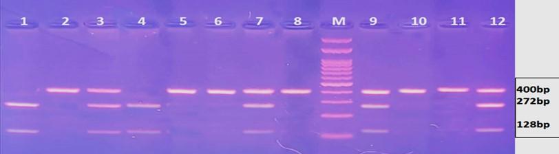 Granzyme B gene polymorphisms and risk of hepatocellular carcinoma in patients with chronic hepatitis