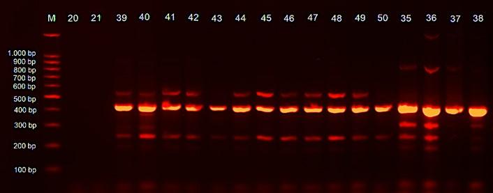 Polymorphisms in the leptin gene and their role in adolescent obesity and metabolic health