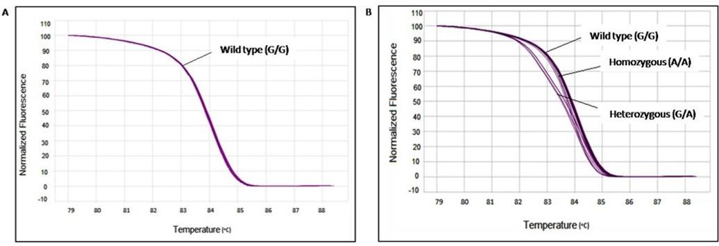 Prevalence of single-nucleotide polymorphism (-308G>A) in the TNF-α promoter region correlates coronary heart disease among type-2 diabetic patients from the northern region of Bangladesh