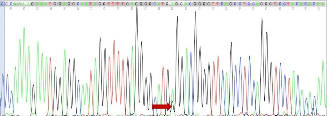 Prevalence of single-nucleotide polymorphism (-308G>A) in the TNF-α promoter region correlates coronary heart disease among type-2 diabetic patients from the northern region of Bangladesh