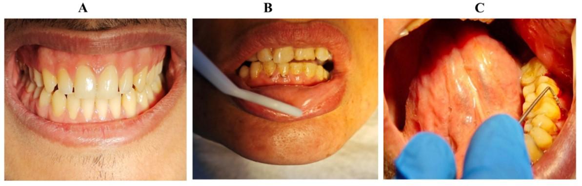 Role of CD117 and mast cells in periodontal diseases: Histological and immunohistochemical study